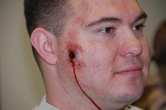 Moulage - Heridas de disparos (entradas) - Imagen 2